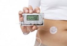 Diabetespatiënten kunnen optimaal controle met een insulinepomp.'